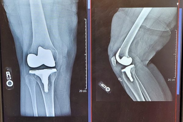 xray-orthopedic-surgery-full-knee-joint-replacem-2021-10-05-05-50-57-utc